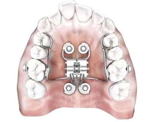 Mini Screw Assisted Rapid Palatal Expansion (MARPE)